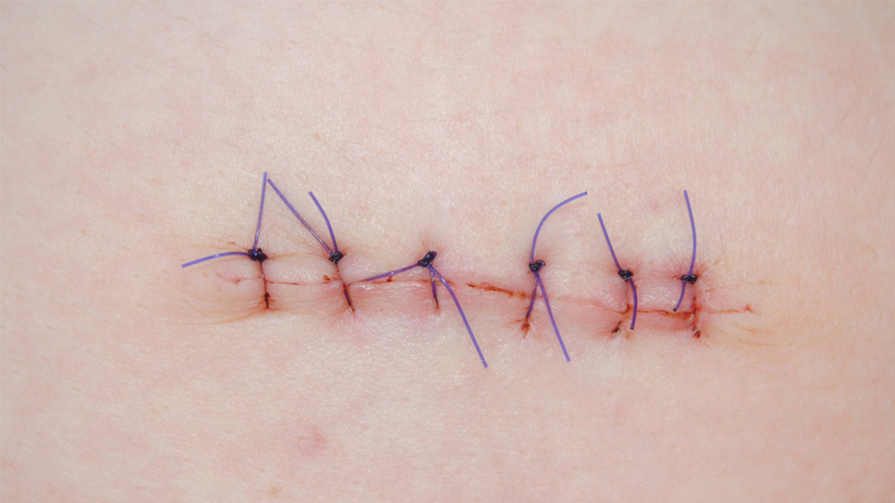 Wound Care: 4 Tips for Taking Care of Stitches - Complete Care
