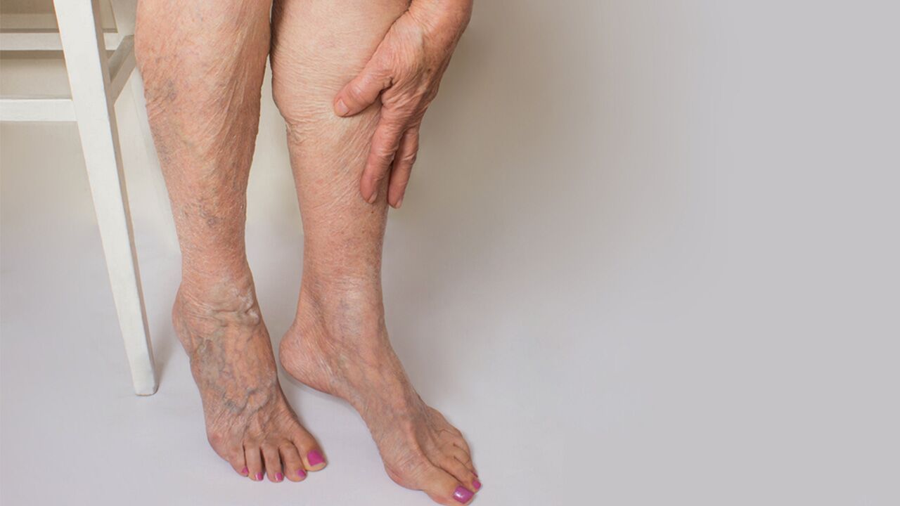 Getting Rid of Varicose Veins: Treatment and Prevention – The Amino Company