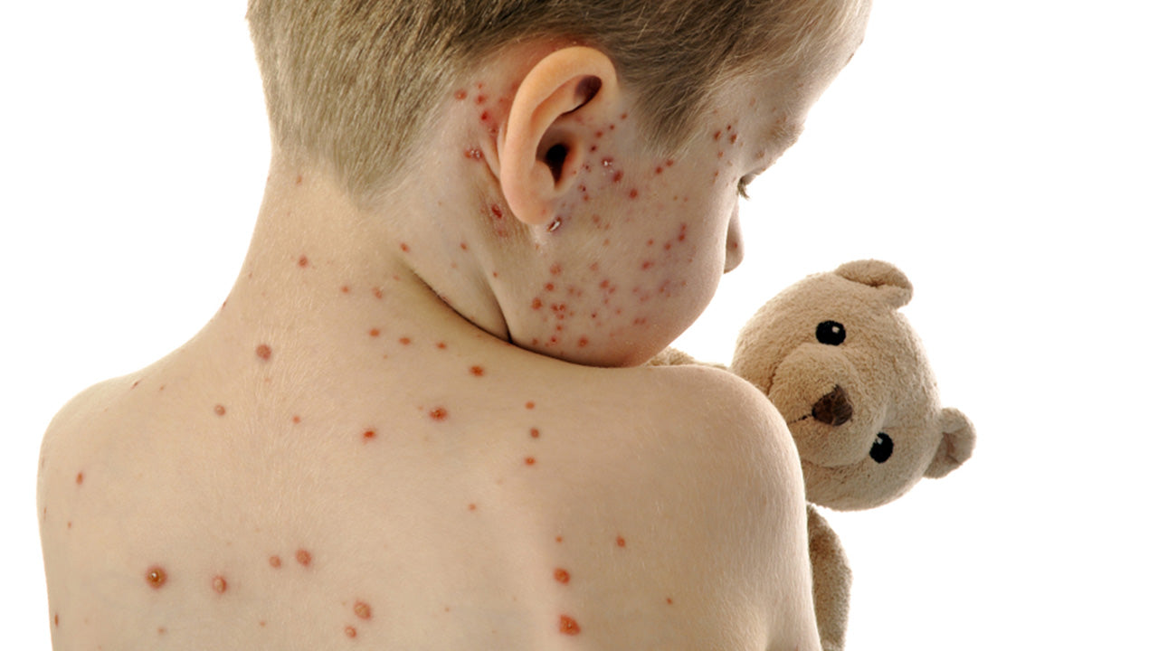 Chickenpox Remedies for Fast Relief – The Amino Company